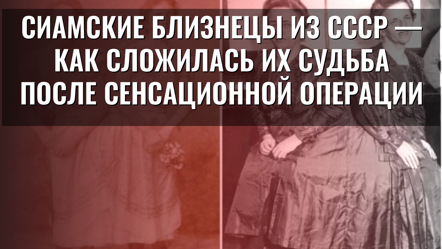 Сиамские близнецы из СССР — как сложилась их судьба после сенсационной операции
