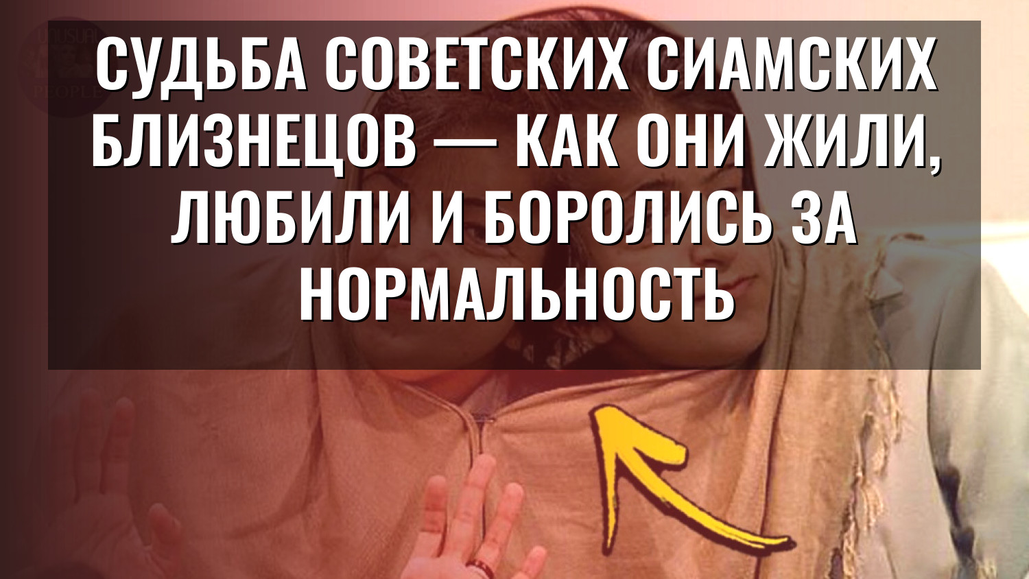 Судьба советских сиамских близнецов — как они жили, любили и боролись за нормальность